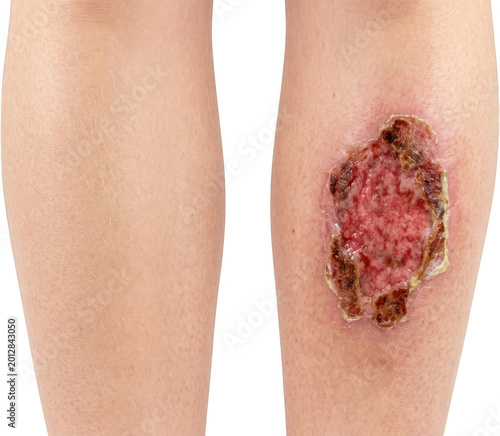 Comparison of a healthy human leg with a severe burn wound showing skin damage and healing process injury medical first degree second degree third degree scar pain inflammation