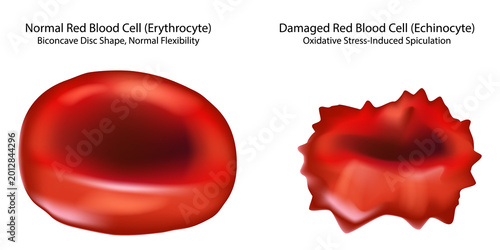 Healthy and Damaged Red Blood Cell Comparison, Echinocyte Formation and Oxidative Stress Medical Illustration. Red Blood Cell Morphology 