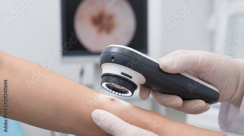 Doctor uses dermatoscope to examine mole on patient's arm for skin cancer screening