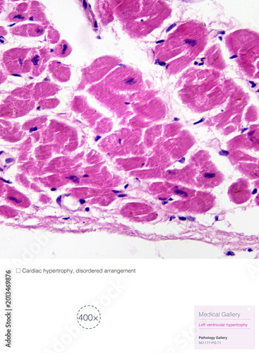 Bild auf Leinwand Left ventricular hypertrophy is seen in diseases such as hypertension