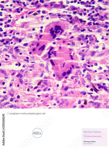 Quadro su tela Langhans giant cells are multinucleated macrophages located at the periphery of a tuberculous nodule