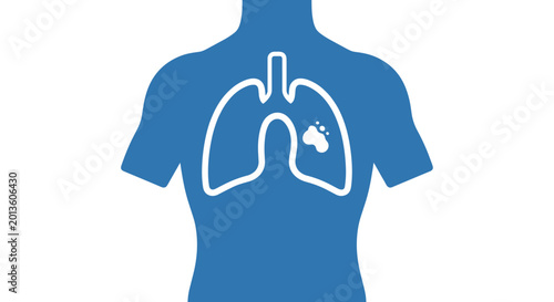 Blue silhouette of human torso with white outline of lungs and highlighted area symbolizing pneumonia, medical illustration with ray-like simplicity