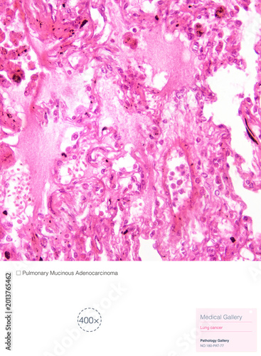 Mucinous adenocarcinoma of the lung is a distinct subtype of pulmonary adenocarcinoma; the neoplastic cells consist of goblet cells or tall columnar cells, and the tumor cells secrete copious amounts 