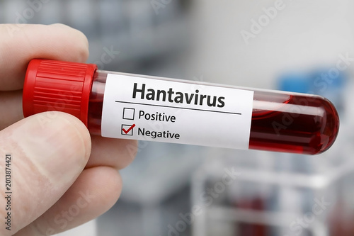Medical concept image showing blood sample tube labeled “Hantavirus” with diagnostic checkboxes.