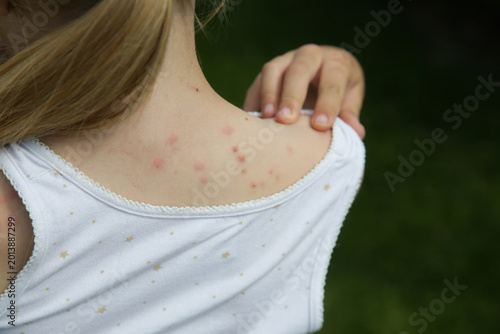 Obraz na plátne Red, swollen and itchy spots on skin caused by insect bites or allergy