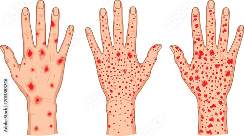 Tableau sur toile Medical Illustration Set of Human Hands with Red Rashes and Lesions Representing