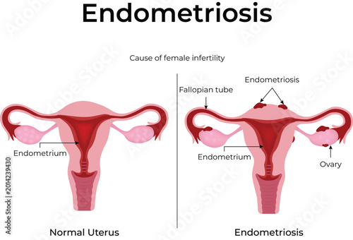 Bild auf Leinwand Endometriosis diagram comparing a normal uterus and an affected female reproductive system showing the cause of infertility