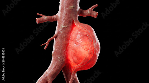3D rendering of a human aorta with a large aneurysm, a diseased blood vessel showing a significant bulge and glowing red on a black background.