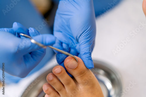 Принти на полотні Podiatrist treating toenail, performing foot care procedure
