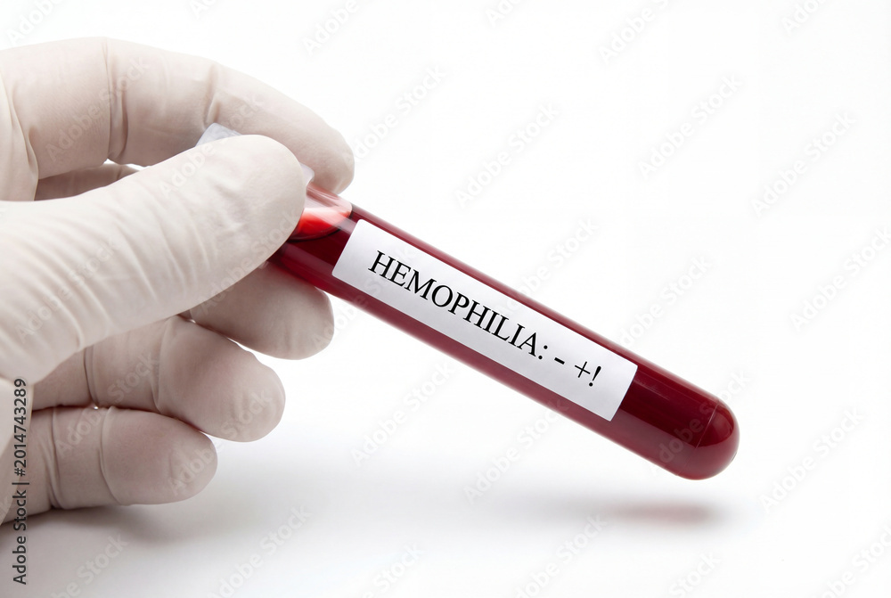 Obraz premium Gloved hand holding blood sample tube labeled for hemophilia test
