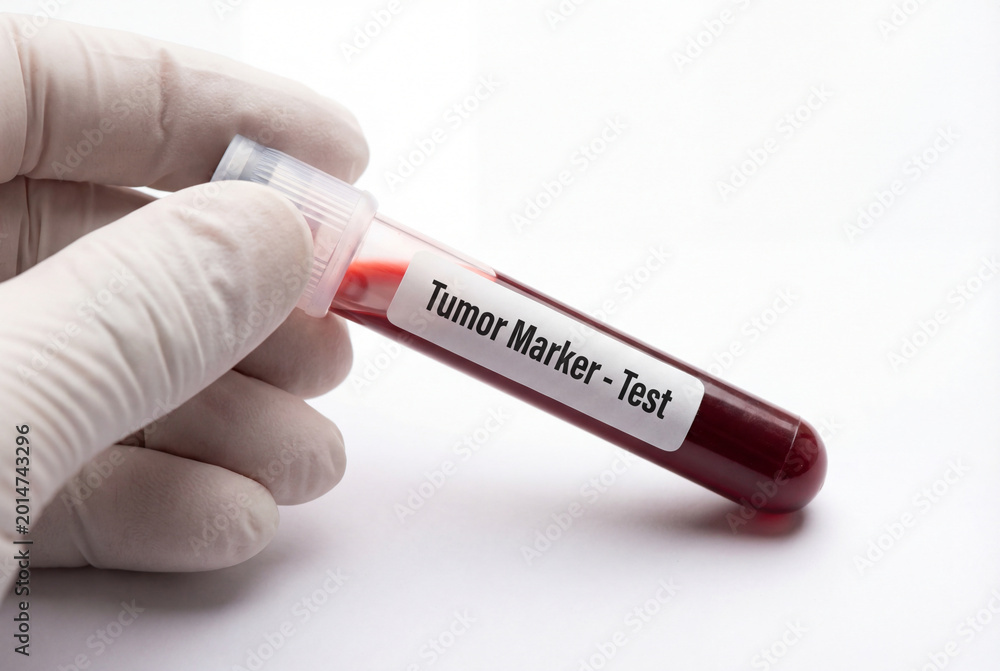 Obraz premium Gloved hand holding blood sample tube for tumor marker test