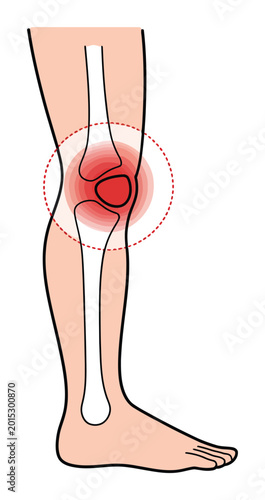 Knee Pain Anatomy Vector Illustration