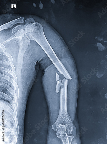 Fotografie Diagnostic radiograph displaying a displaced, comminuted mid-shaft fracture of the left humerus