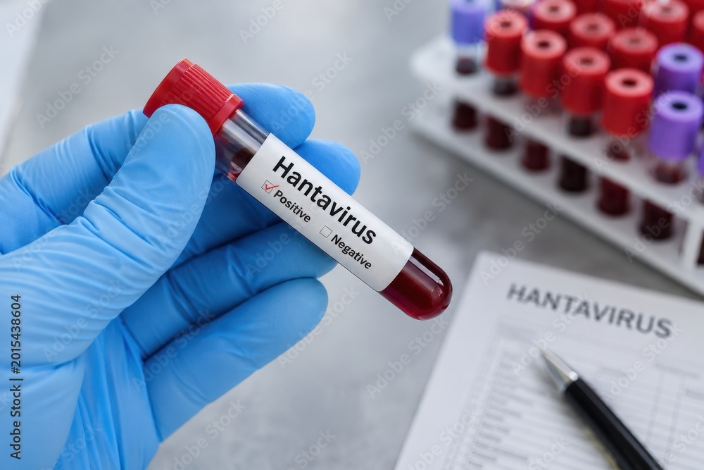 Fototapeta premium Medical professional holding a laboratory sample for Hantavirus testing. Clinical diagnostics, virus infection research, and blood analysis concept.