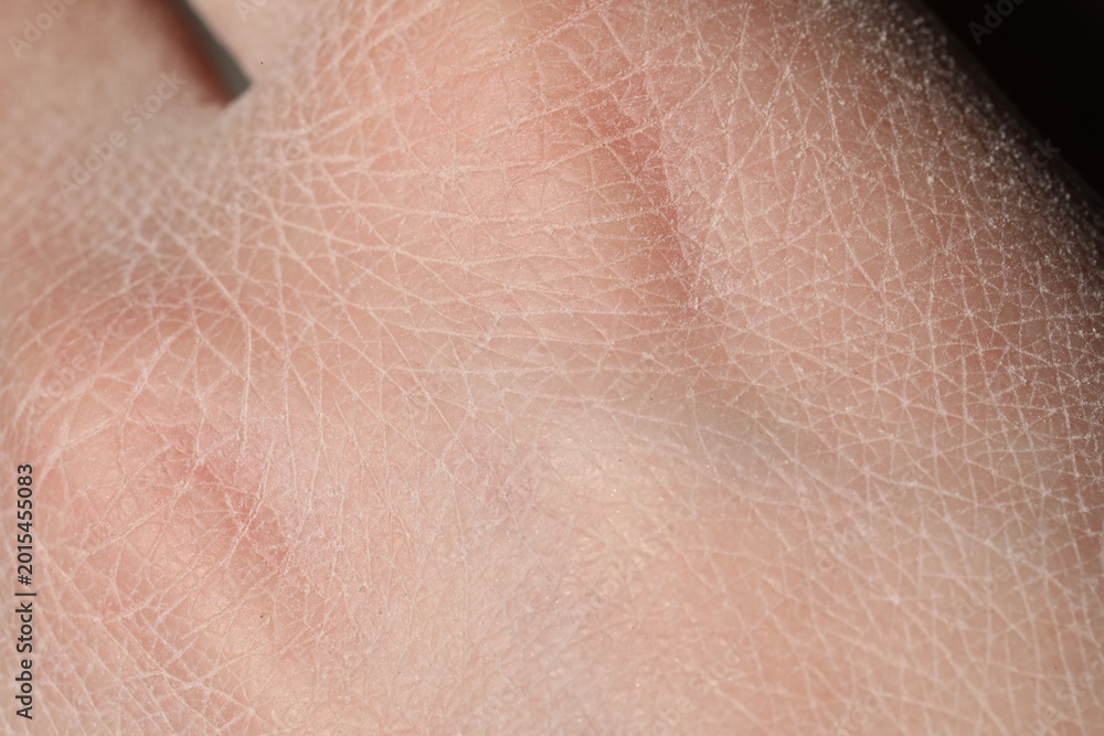 Fototapeta premium Man with dry skin on his hand, closeup