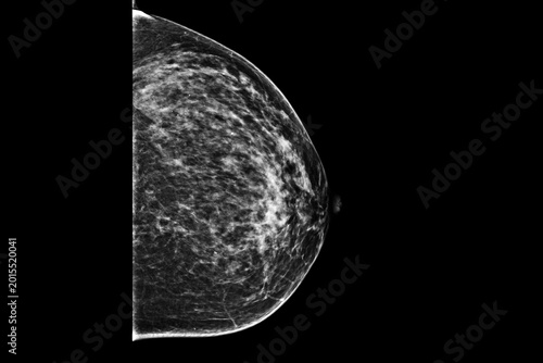 Medical themes: Mammography showing coarse calcifications belonging to a fibroadenoma.