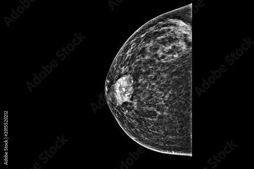 Quadro su tela Medical themes: Mammography showing coarse calcifications belonging to a fibroadenoma