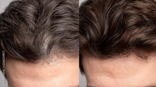 Close-up comparison of a man's hairline showing sparse hair growth and thinning areas versus a fuller, denser appearance after hair restoration.
