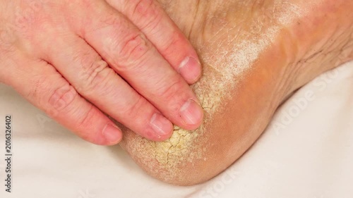 A hand feels a cracked heel in bed. An elderly person's hand touches a heel with deep fissures against a white sheet. Elderly health. The consequences of diabetes. A diseased foot. A hospital ward. 4k