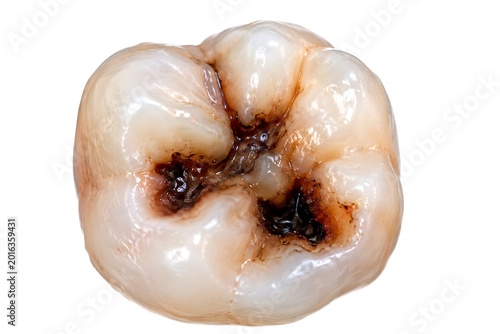 Deep Dental Cavity and Tooth Decay Illustration on Isolated White Background for Medical Education