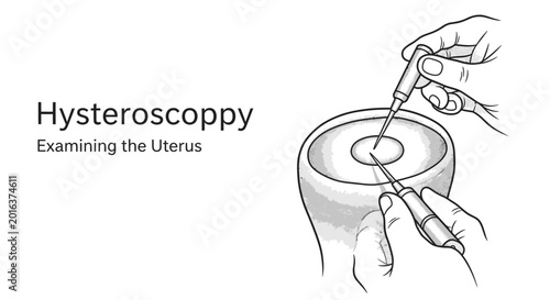 Tableau sur toile Hysteroscopy medical procedure illustration for examining the uterus anatomy