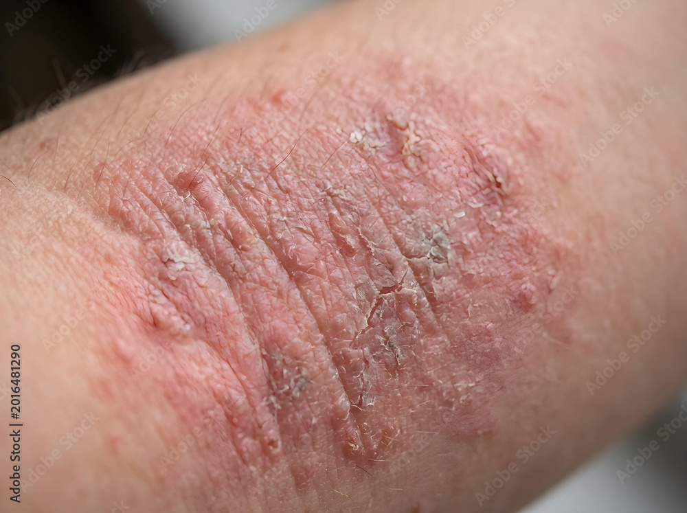 Fototapeta premium close-up of human forearm with severe eczema and dry flaky skin texture