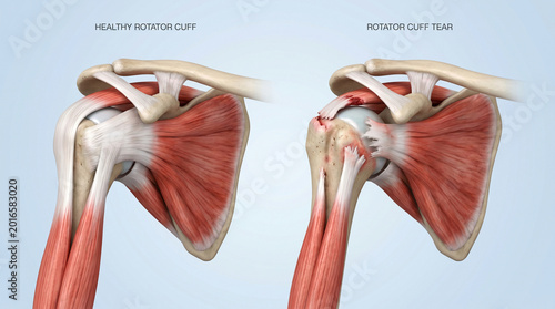Shoulder Rotator Cuff Tear Anatomy Healthy vs Injured Joint Injury