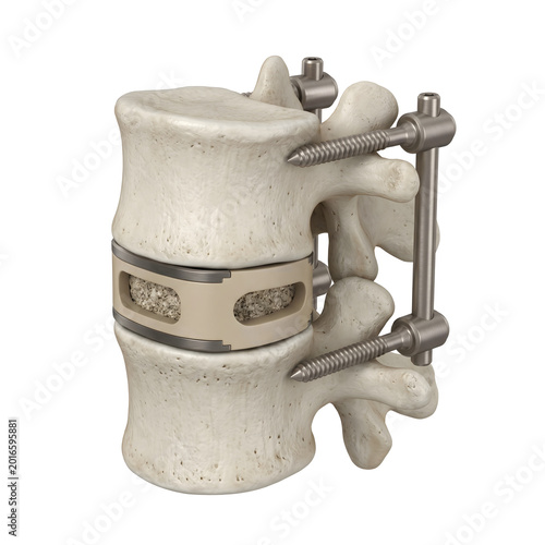 Spinal fusion implant kit — realistic 3D render medical illustration