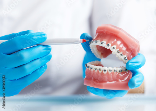 Obraz na plátne Close up of doctor orthodontist showing model of human jaw with wire braces atta
