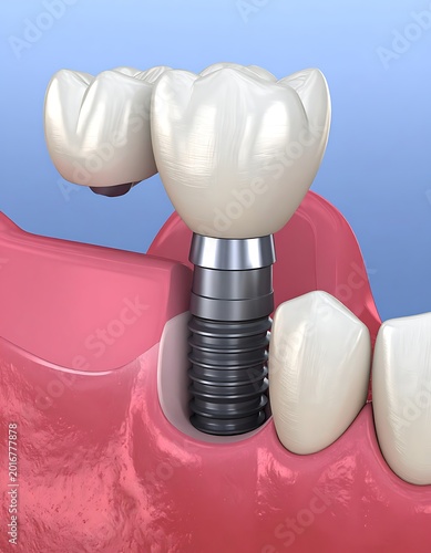A dental implant with artificial teeth and gum