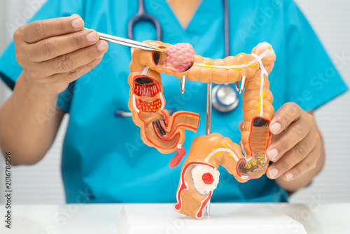 Colorectal cancer, doctor holding intestine colon human model.