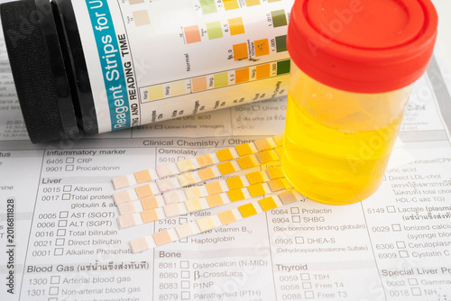 Urinalysis, urine cup with reagent strip pH paper test and comparison chart in laboratory.