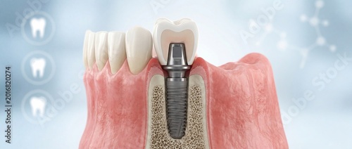 Dental implant structure with crown placement in 3D medical concept