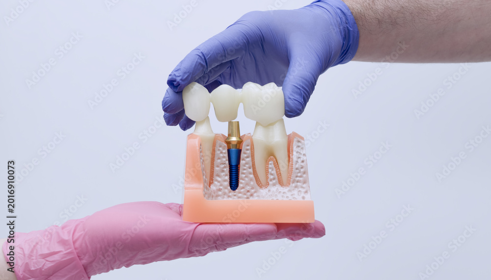 Naklejka premium Dentist hands in blue and pink gloves placing a dental bridge onto an anatomical implant model. Cross-section jawbone.