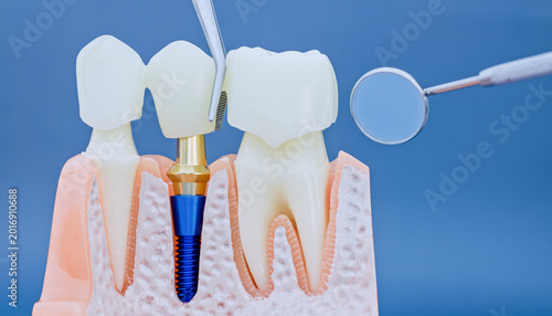 Macro photography of dental prosthodontics: placing a tooth bridge on a titanium implant with professional tools.