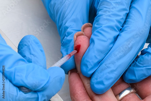 Close-up of a healthcare worker in blue nitrile gloves collecting a capillary blood sample from a patient's fingertip using a glass capillary tube for medical testing and diagnostics.