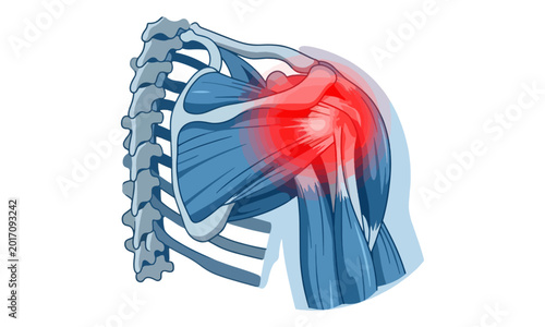 Quadro su tela Shoulder Muscle Pain Anatomy Illustration on White Background