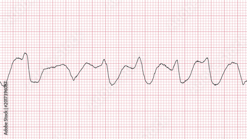 Foto Patient Heart Rate ECG Monitor Medical Illustration Graphic Design Layout