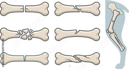 Foto Broken bone illustrations showing fractures and skeletal trauma