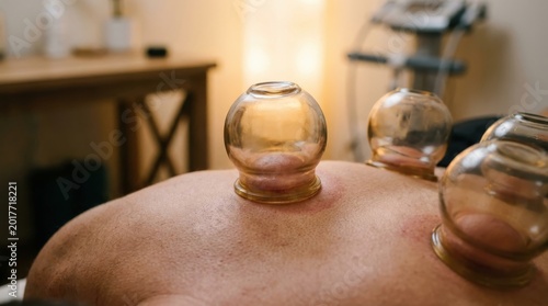 Cupping Therapy Jars on Back: Hijama Suction for Pain Relief, Detox, Circulation & Muscle Recovery