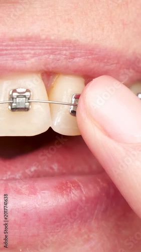 Close-up of finger touching dental braces on teeth. Orthodontic care and teeth alignment concept. Vertical shot showing personal oral hygiene and smile improvement process.