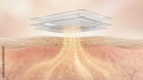 Medical device emitting golden particle beam penetrating into layered skin tissue below