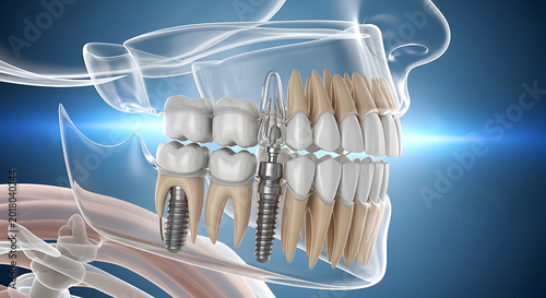 dental implants and teeth with gum and jawbone blue background high quality
