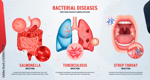 Tableau sur toile Tuberculosis and Salmonella Infection Banner Set