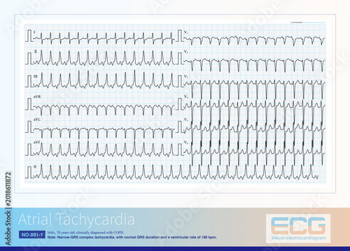 Bild auf Leinwand A 69-year-old male with a clinical diagnosis of COPD