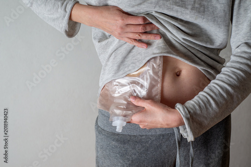 Young white woman with a colostomy bag exercising with dumbbells
