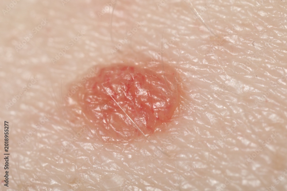 Fototapeta premium Macro view of skin with birthmark as background