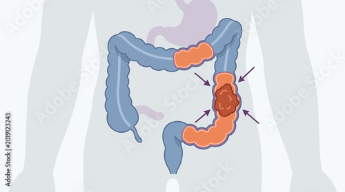 Illustration of a human colon with a tumor or polyp in the large intestine