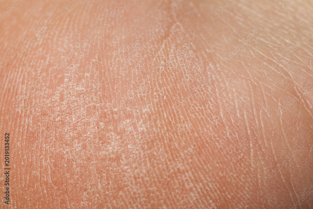 Fototapeta premium Texture of dry skin as background, closeup