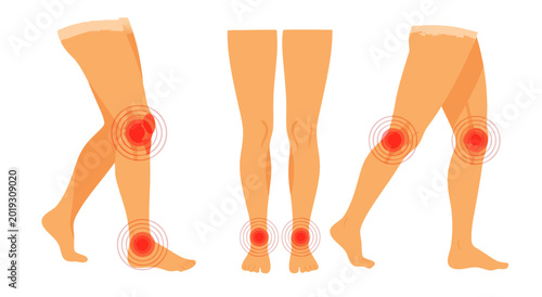 Tableau sur toile Anatomical vector illustration of three human legs in various positions showing knee pain